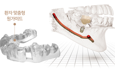 환자 맞춤형 가이드와 임플란트 식립 계획 3D 이미지